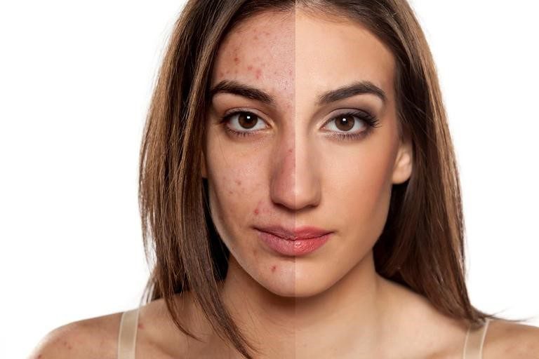 clear face without acne